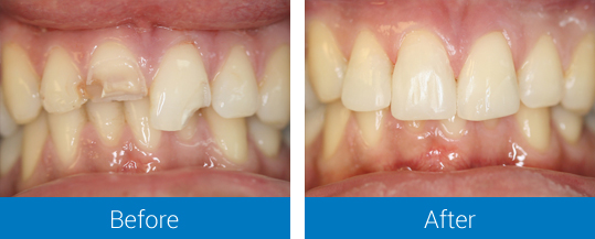 Restoring Decayed and Broken Tooth with White Fillings and Crowns